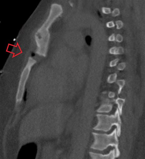 barrel compression test sternal fracture|sternum fracture.